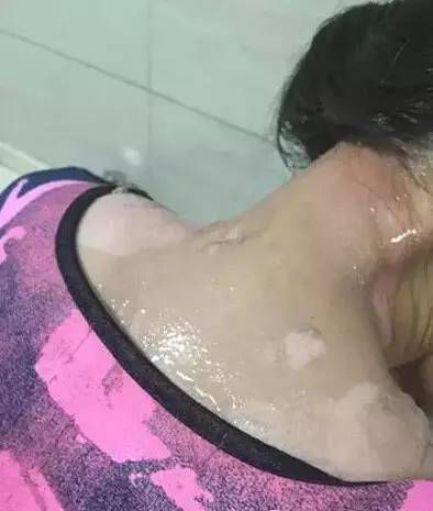 令人發指！火鍋店服務員與女顧客起爭執，竟將一鍋滾湯澆在她頭上！ 